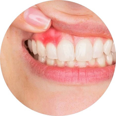 Баннер Лечение пародонтоза